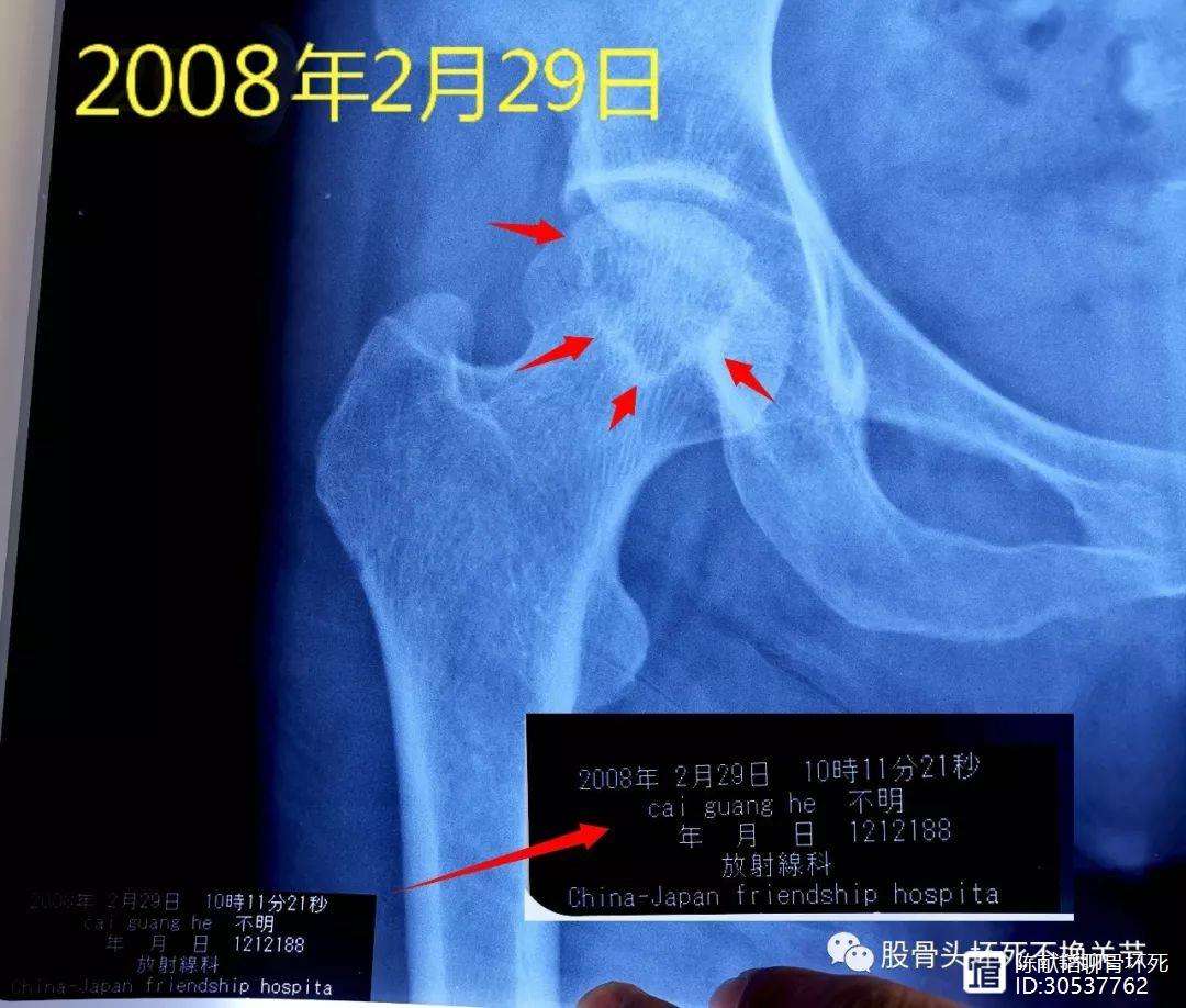 江津人工骨头医保报销多少(人工骨头医保报销多少比例)