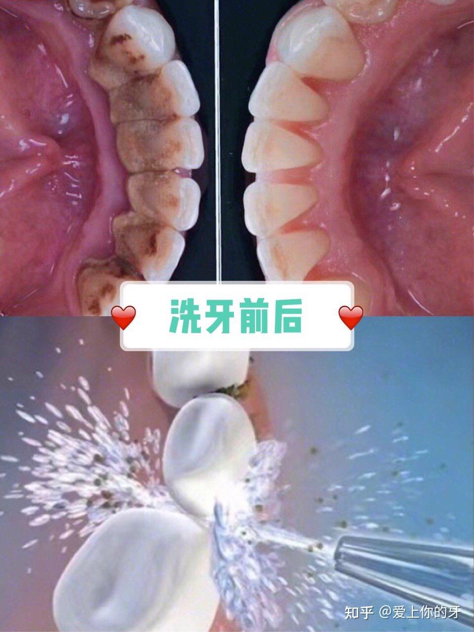 江津洗牙可以用医保吗(洗牙可以用医保吗,报销比例多少)